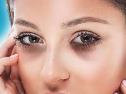 आँखों के नीचे काले घेरे मिटाने के घरेलु उपाय