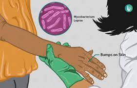 कुष्ठ  ( Leprosy  ) रोग के असरकारी आयुर्वेदिक उपचार