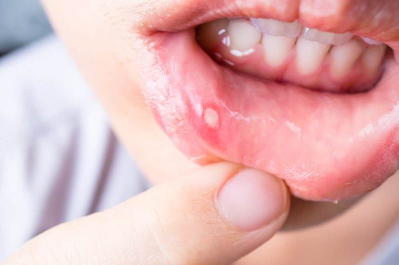 Oral Ulcers & Infection
