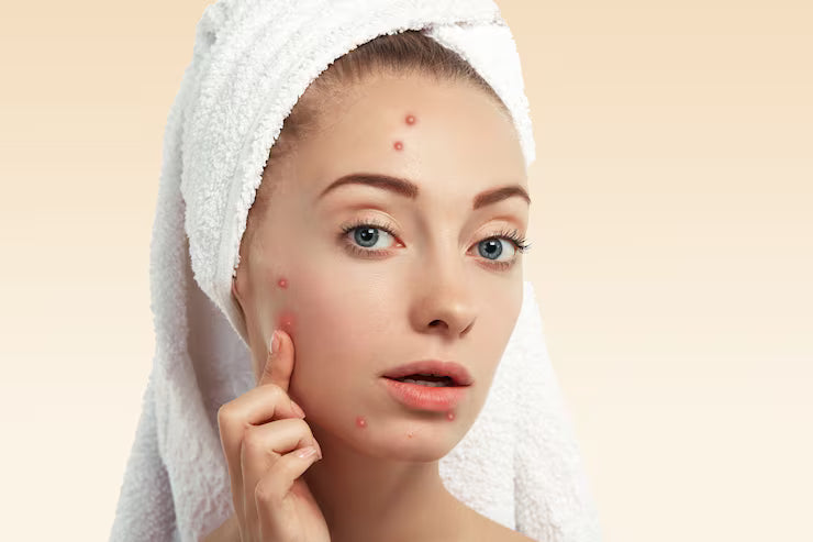 Pimples & Acne Care